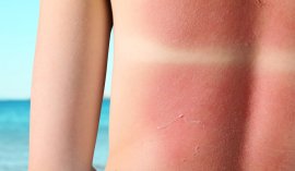 Sole e pelle: la melanina non basta a proteggerci