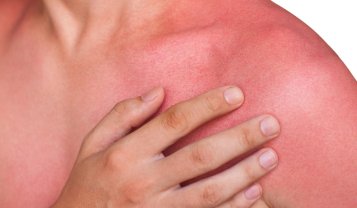 Dopo-sole: cosa serve davvero alla tua pelle