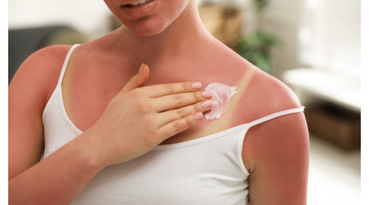 Come prendersi cura della pelle dopo una giornata di sole Come prendersi cura della pelle dopo una giornata di sole