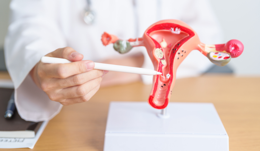 Cos'è l'endometriosi e come si cura